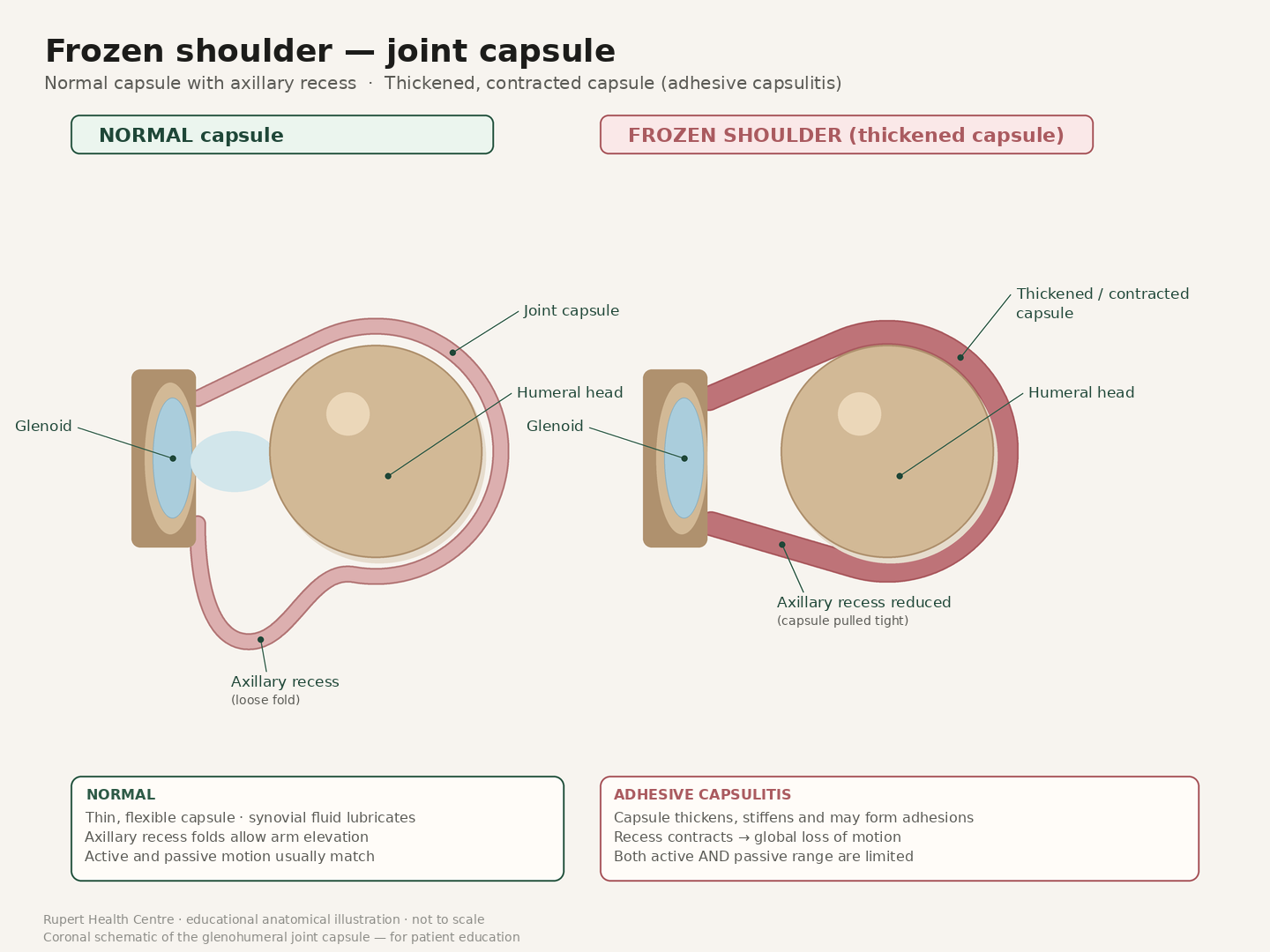 Labeled side-by-side anatomical illustration of the shoulder joint. Left: normal glenohumeral joint with glenoid, humeral head, thin joint capsule and a loose axillary recess fold. Right: frozen shoulder with a thickened, contracted capsule and a reduced, tight axillary recess.