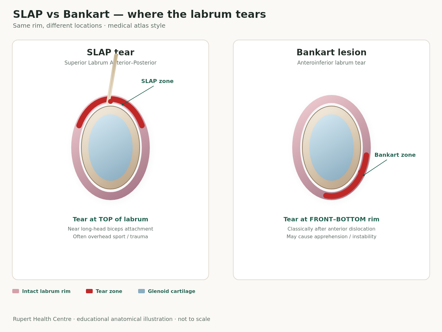 Side-by-side anatomical illustrations of the shoulder socket highlighting the superior SLAP tear zone near the biceps attachment versus the anteroinferior Bankart tear zone.